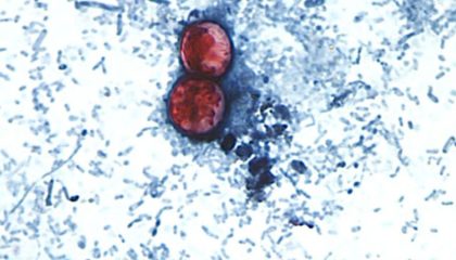 170807210626-new-cyclosporiasis-outbreak-0807